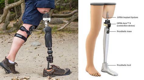  Orthopaedic Composites: Revolutionizing Medical Implants and Prostheses!