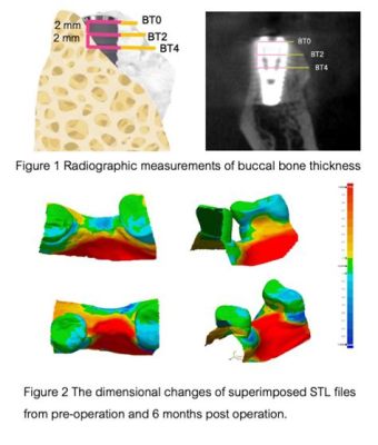  Tricalcium Phosphate: Revolutionizing Orthopedic Implants and Bone Regeneration!